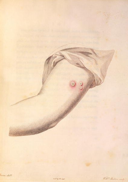 Arm of William Pead used for smallpox vaccine, from An Inquiry into the Causes and Effects of the Variolae Vaccinae by Edward Jenner 1748-1823 engraved by Pearce, c.1800