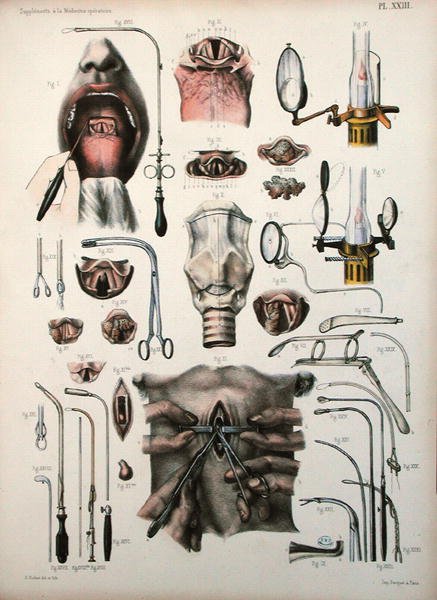 Tracheotomy operation, plate from Traite Complet de lAnatomie de lHomme by Jean-Baptiste Marc Bourgery 1797-1849 1866-67