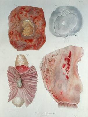 Organs infected with cholera