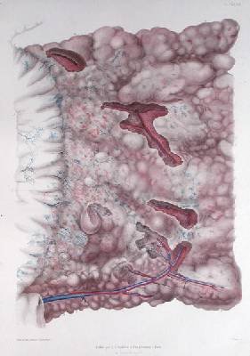 Cancer of the epiploon