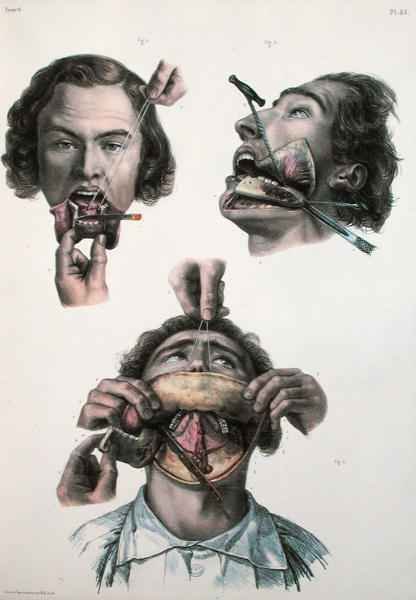 Operation on the lower jaw