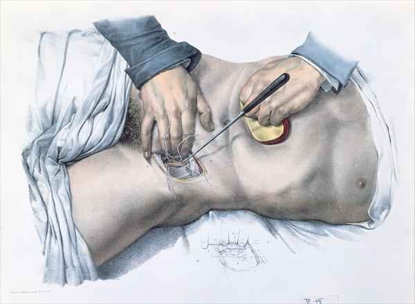 Tying up an artery