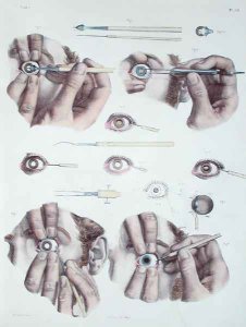 Operation on a eye