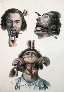 Operation on the lower jaw